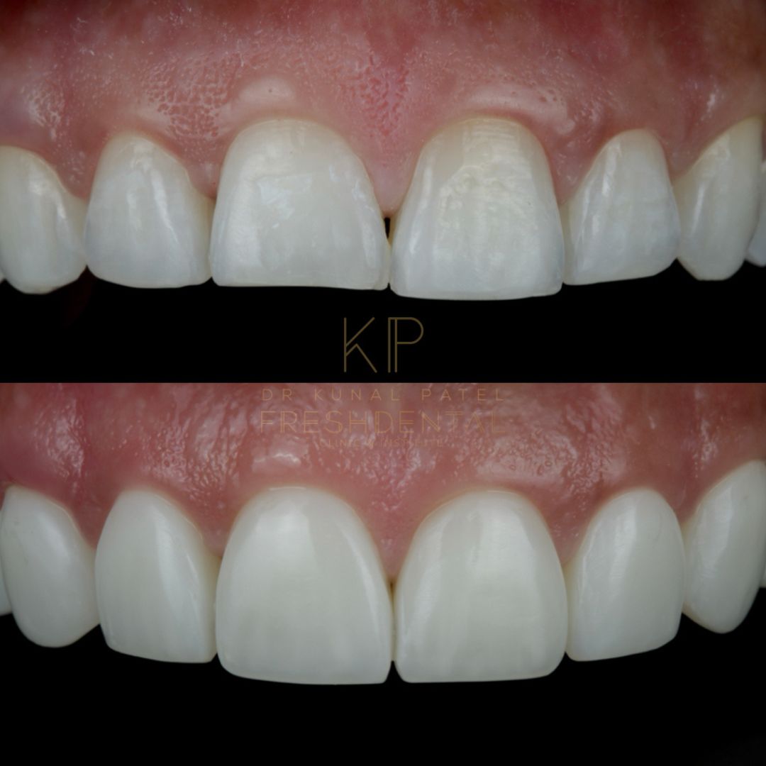 Fresh Dental composite bonding result 2