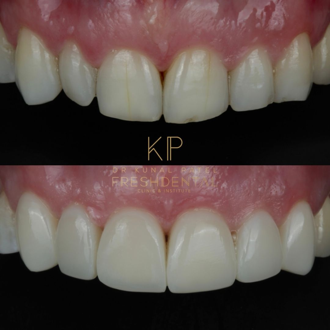 Fresh Dental composite bonding result 3