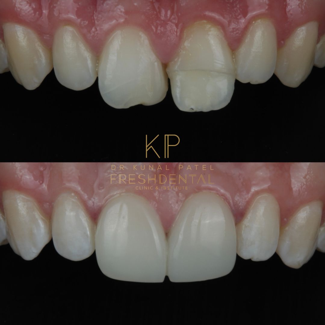 Fresh Dental composite bonding result 5