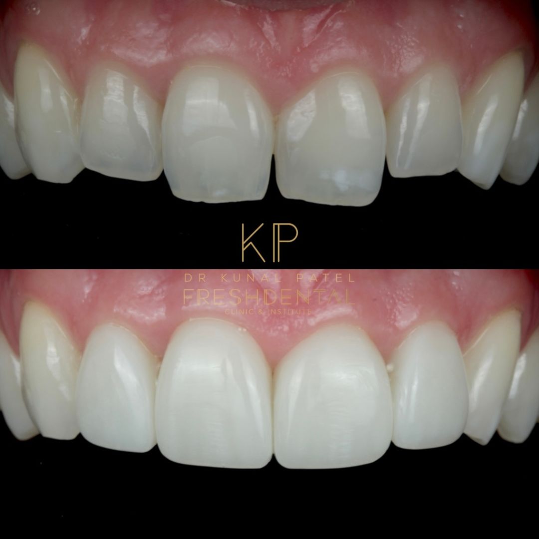Fresh Dental composite bonding result 6